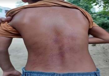 শিশু শিক্ষার্থীকে পিটিয়ে জখম করল মাদরাসা শিক্ষক